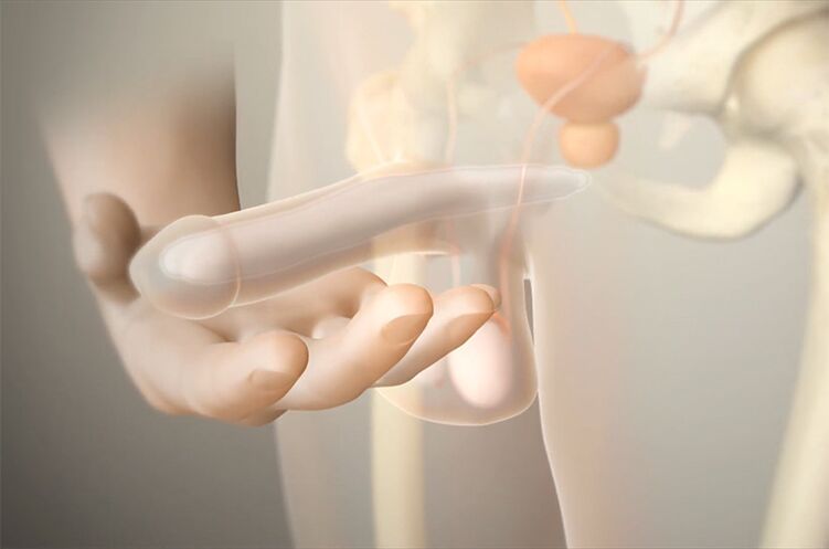 a'zoni ko'paytirish uchun Gel implantlari