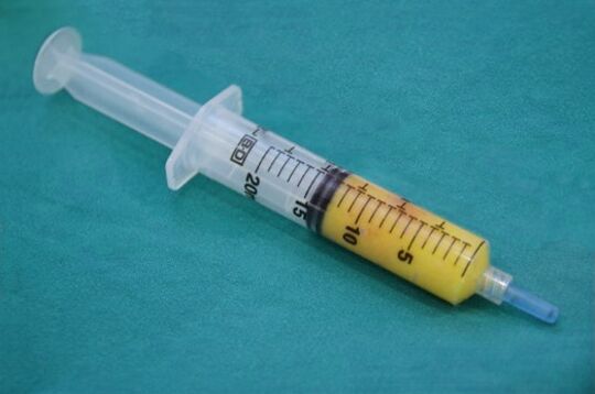 Lipofilling uchun yog 'to'qimasi bilan shprits