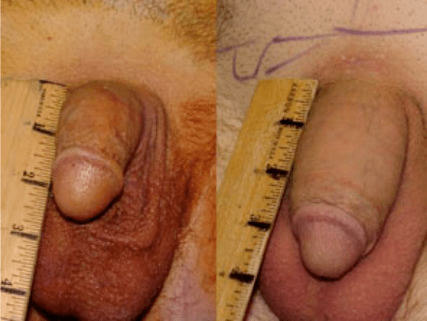 Lipofilling va jel implantatsiyasidan oldin va keyin