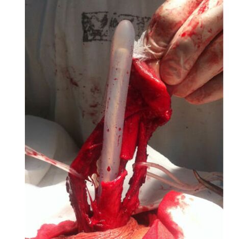 Jinsiy olatni kattalashtirish uchun mushak to'qimalarining transplantatsiyasi